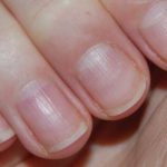 Nail ridges: an expert shares causes & how to treat