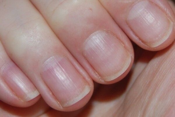 Nail ridges: an expert shares causes & how to treat